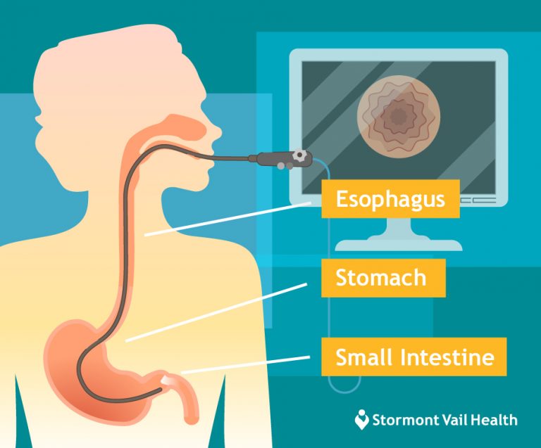 EGD Examine Your Esophagus, Stomach, and Duodenum