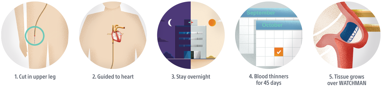 graphics showing the process of the getting the watchman procedure