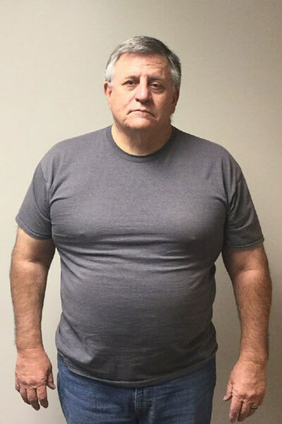 Before weight loss