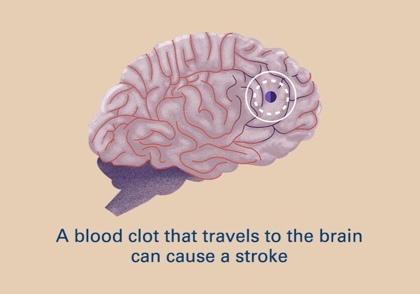 graphic of a brain with a blood clot