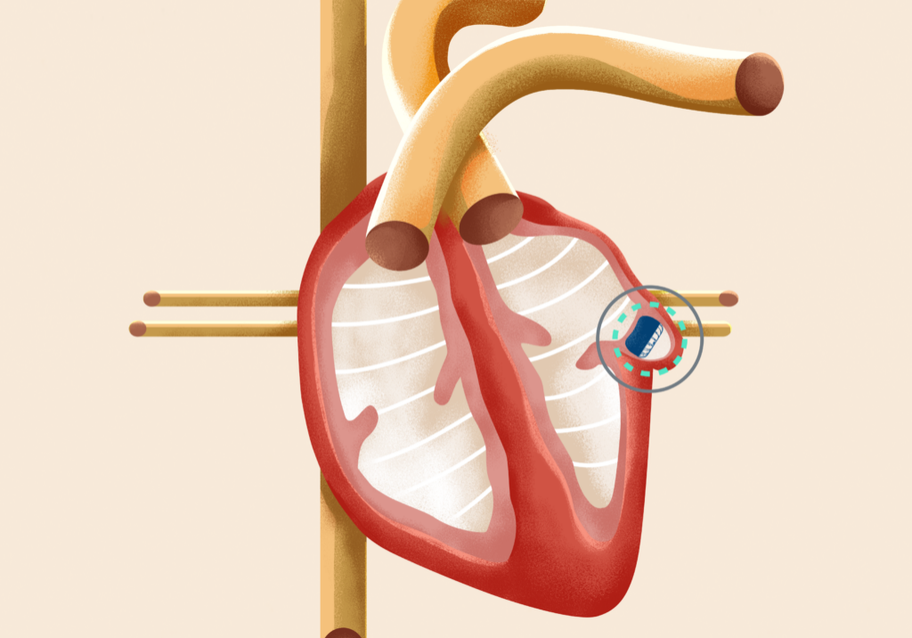 More than 90% of stroke-causing clots that come from the heart are formed in the LAA.