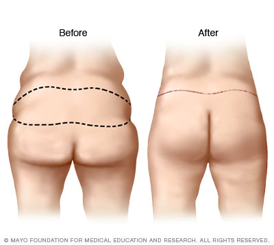 Illustration of buttock lift results 

