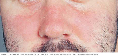 Seborrheic dermatitis on the face