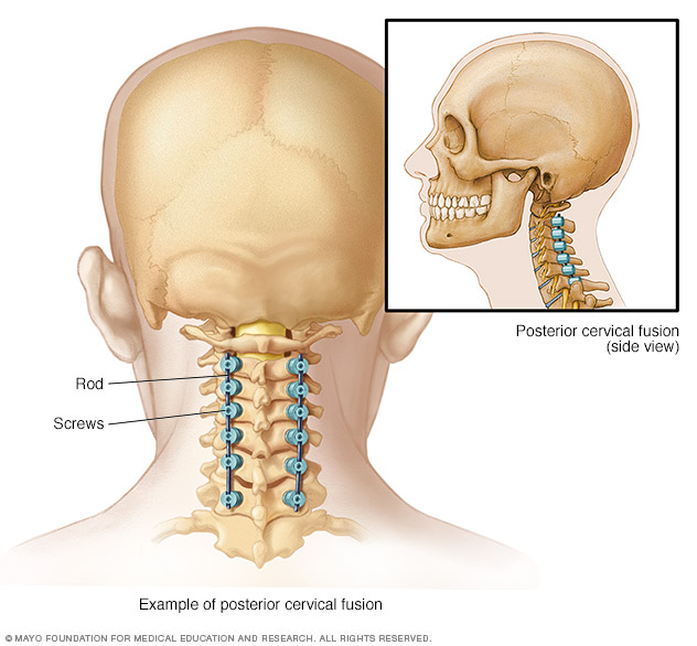 Illustration showing hardware used to fuse spine from back of neck.
