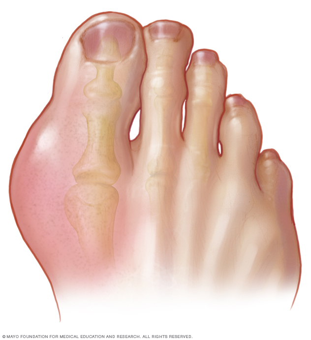 Gout in the big toe