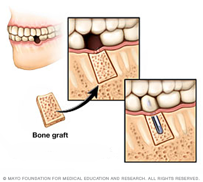 Bone grafting in the jawbone 