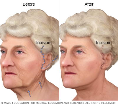 Illustration of a face-lift
