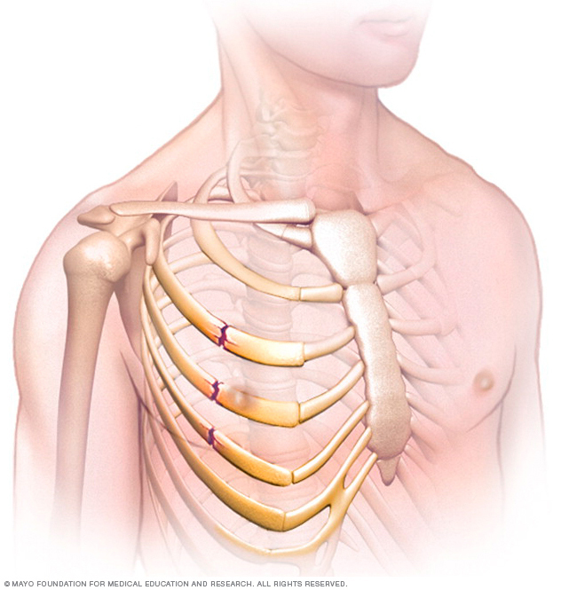 Illustration showing broken ribs 