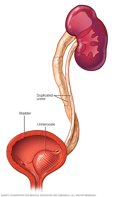 Illustration showing a cutaway view of the bladder with a ureterocele inside and two ureters coming into the bladder.