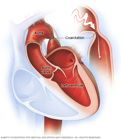 Illustration showing coarctation of the aorta