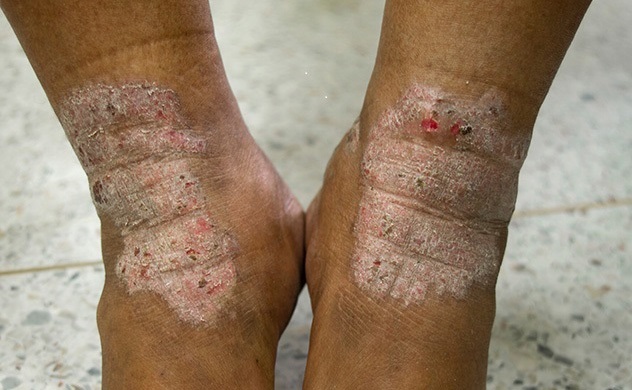 Leaking sores of atopic dermatitis