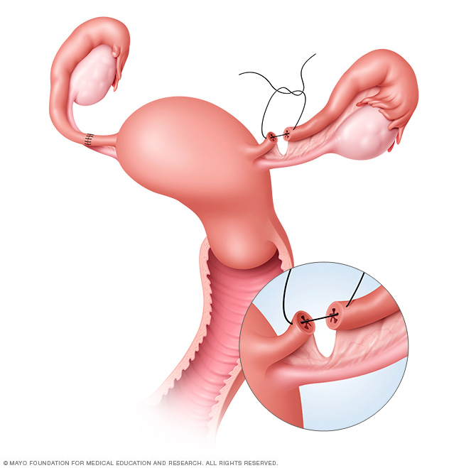 Fallopian tube segments being reconnected