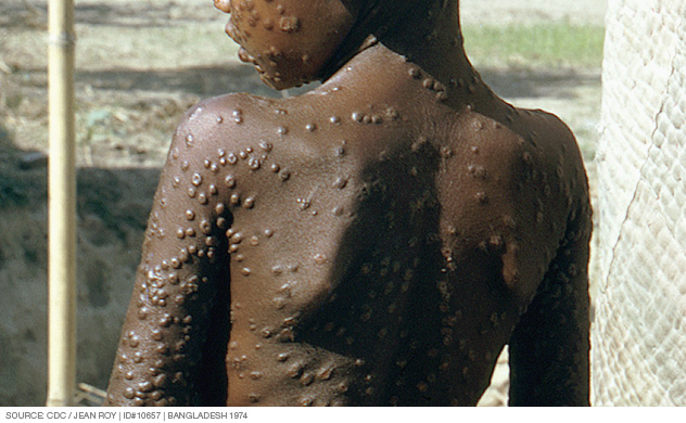Smallpox pustules covering the trunk of the body