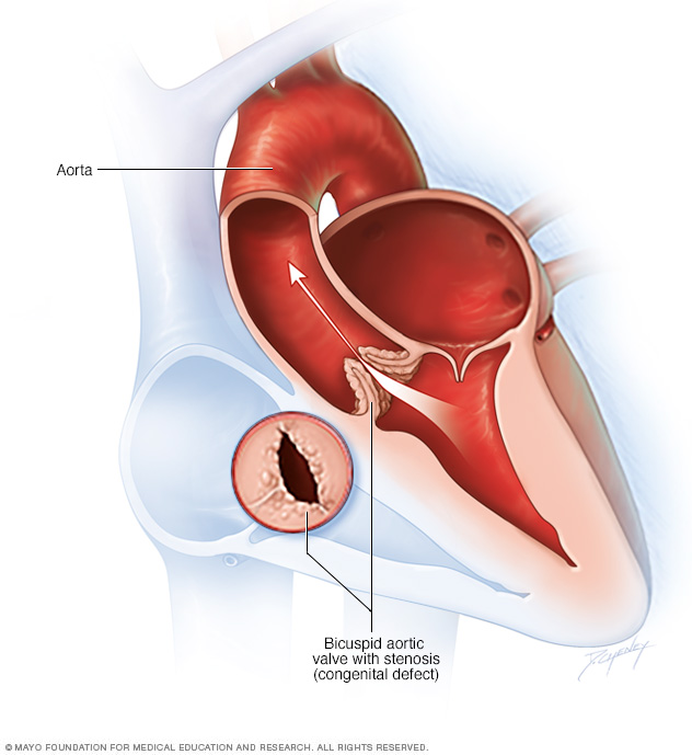 Bicuspid aortic valve with stenosis