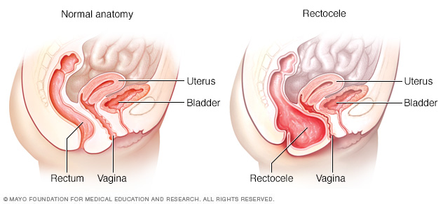 Illustration showing normal anatomy and posterior vaginal prolapse (rectocele)