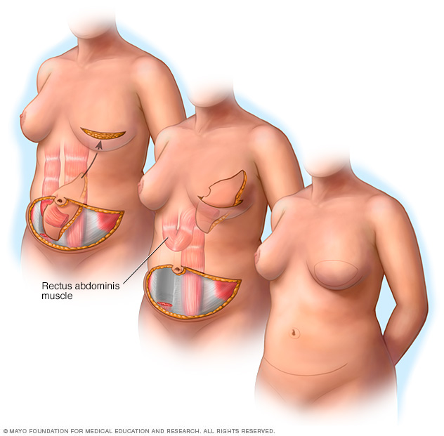 Illustration showing a pedicle TRAM flap procedure