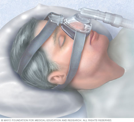 Continuous positive airway pressure (CPAP) mask
