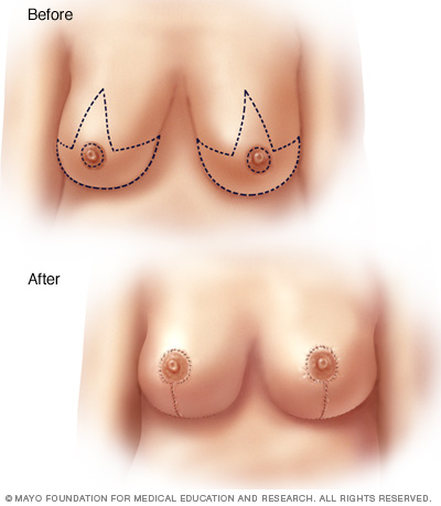 Breast lift illustration
