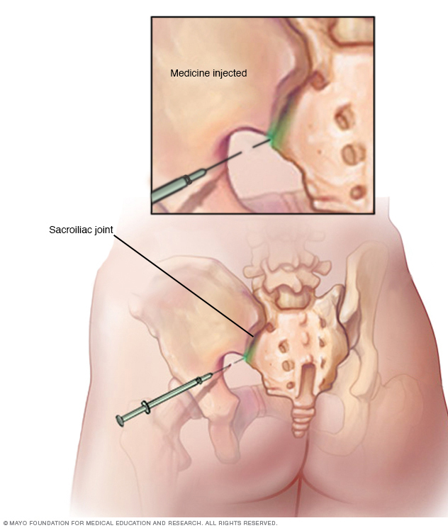 Placement of sacroiliac injection 