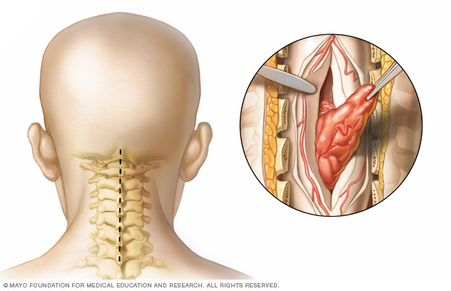 Spinal tumor neck surgery