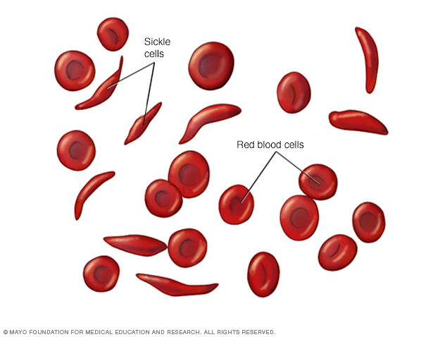 Normal red blood cells and sickle cells