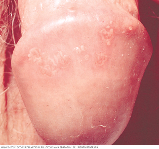 Photograph of genital herpes blisters on a penis