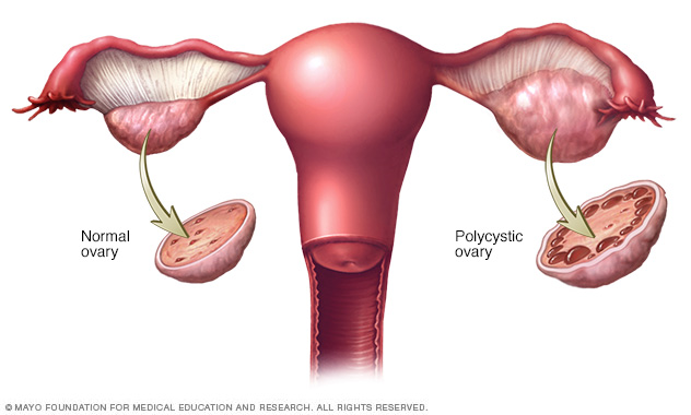 Normal ovary and polycystic ovary 