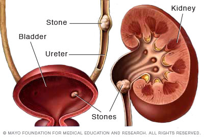 Illustration showing kidney stones 
