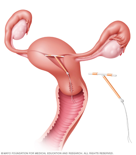 Illustration showing ParaGard IUD in place in the uterus
