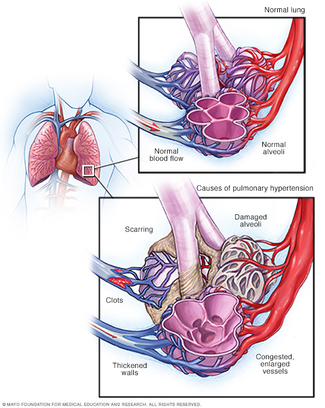 Blood flow in lungs, and normal and blocked pulmonary arteries