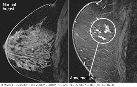 Breast MRI images