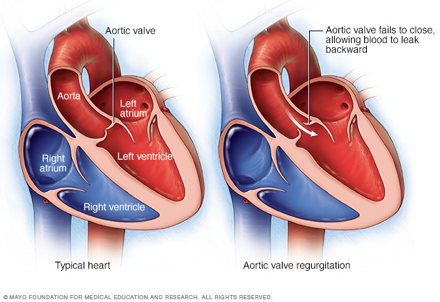 Aortic valve regurgitation