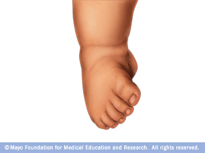 Baby with clubfoot