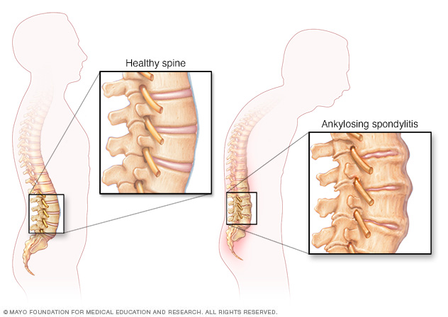 Spinal changes in ankylosing spondylitis