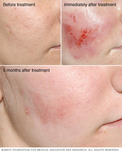 Before, immediately after and months after dermabrasion photos