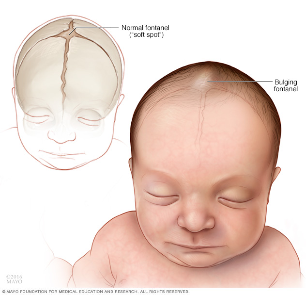 Normal vs. abnormal soft spots (fontanels) of a baby's skull