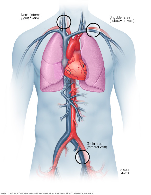Where catheters are inserted for cardiac ablation