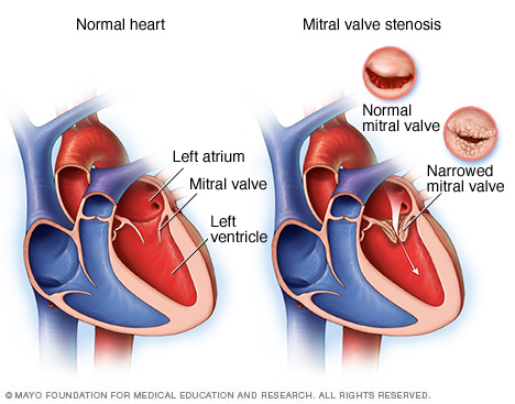 Normal heart and heart with mitral valve stenosis