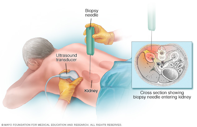 Kidney biopsy procedure