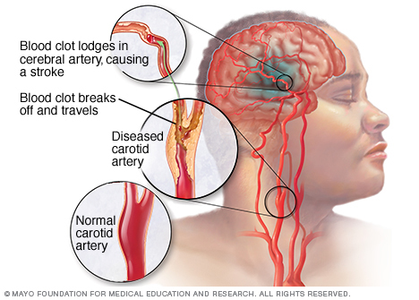 Illustration showing ischemic stroke