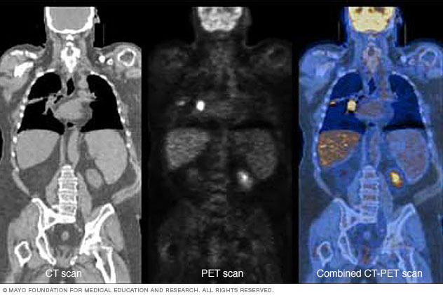 PET scan combined with CT scan