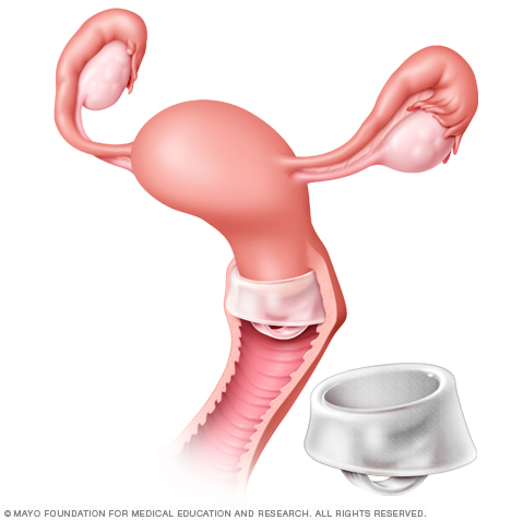 Where the cervical cap is placed in the vagina