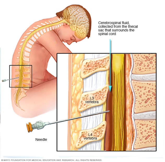 Spinal tap (lumbar puncture)