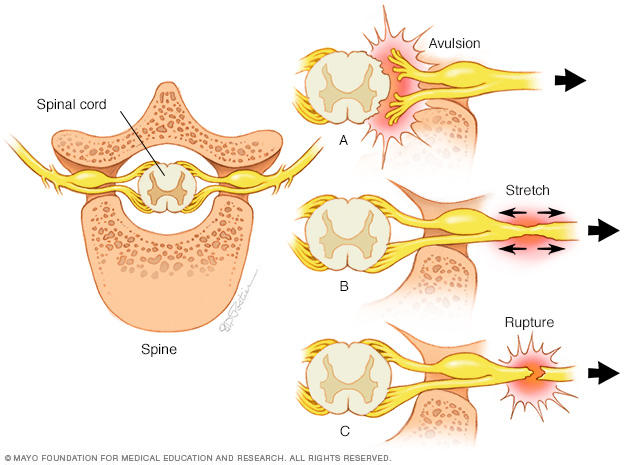 Avulsion, stretch and rupture types of nerve injuries
