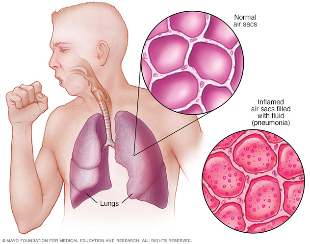 Lungs with pneumonia