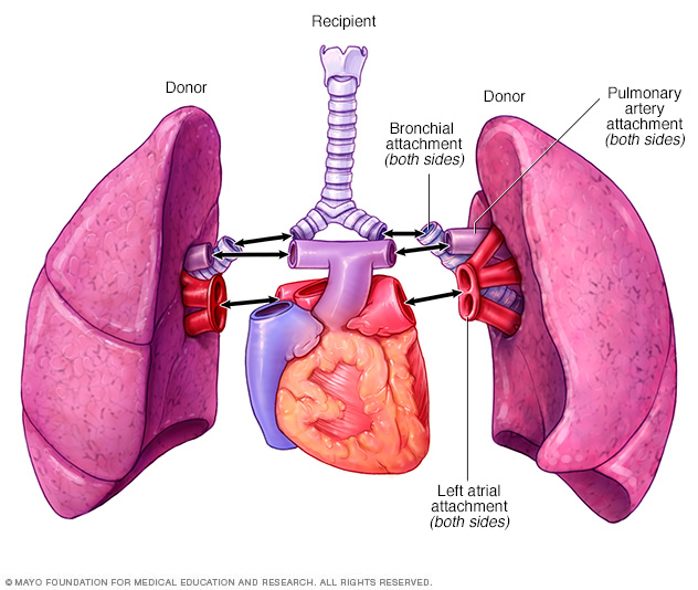 Double-lung transplant