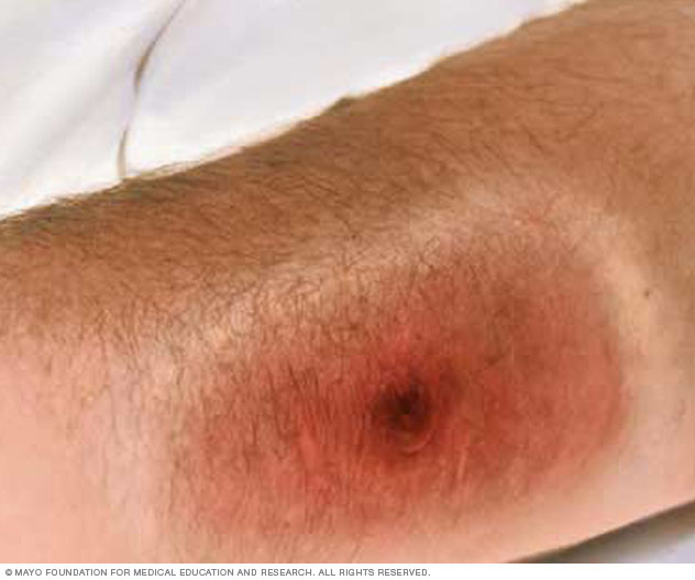 A large sore with a black center, caused by cutaneous anthrax