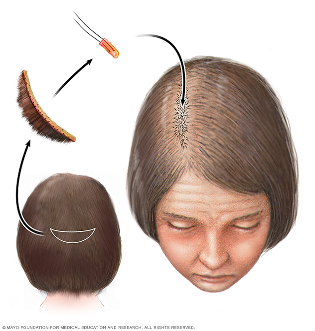Hair transplant for hereditary hair loss