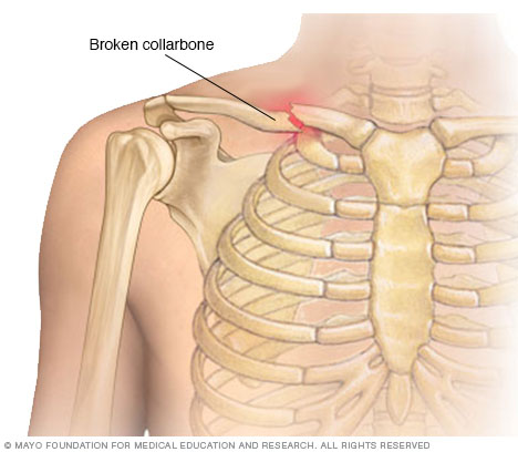 Illustration showing a broken collarbone
