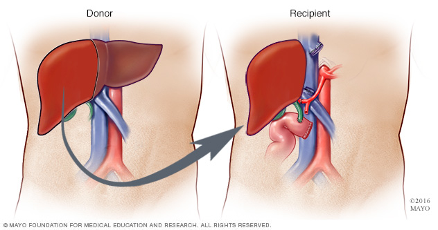 Living liver donor procedure